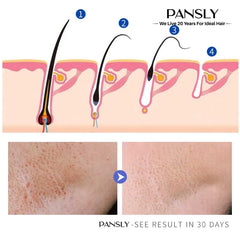 كريم منع نمو الشعر الدائم للحية والبكيني والساقين والجسم والإبط يوقف نمو الشعر ويقلص المسام وينعم البشرة